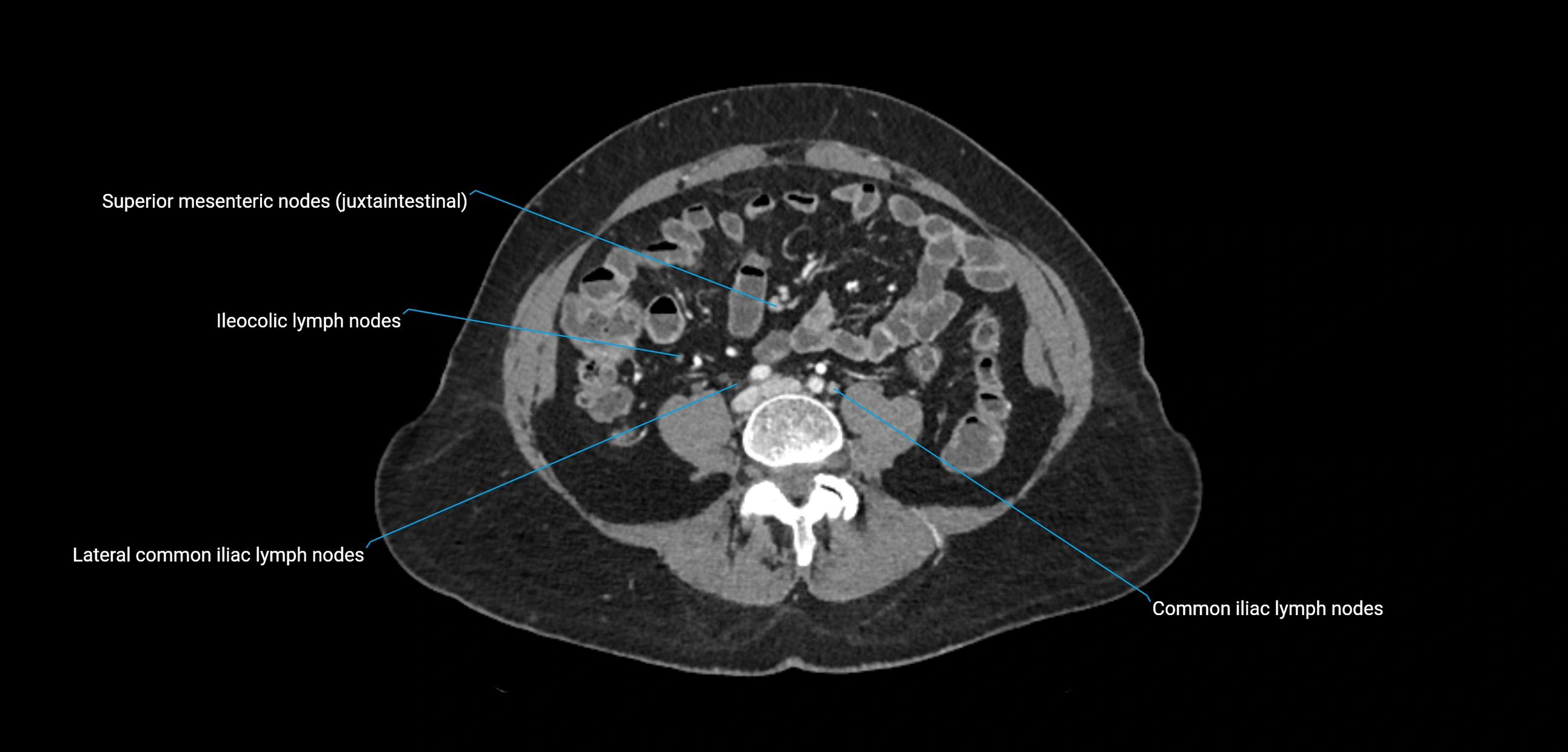 CT ct abdominal lymph nodes  axial cross sectional anatomy  enchanced radiology image -img-00002-00279.webp